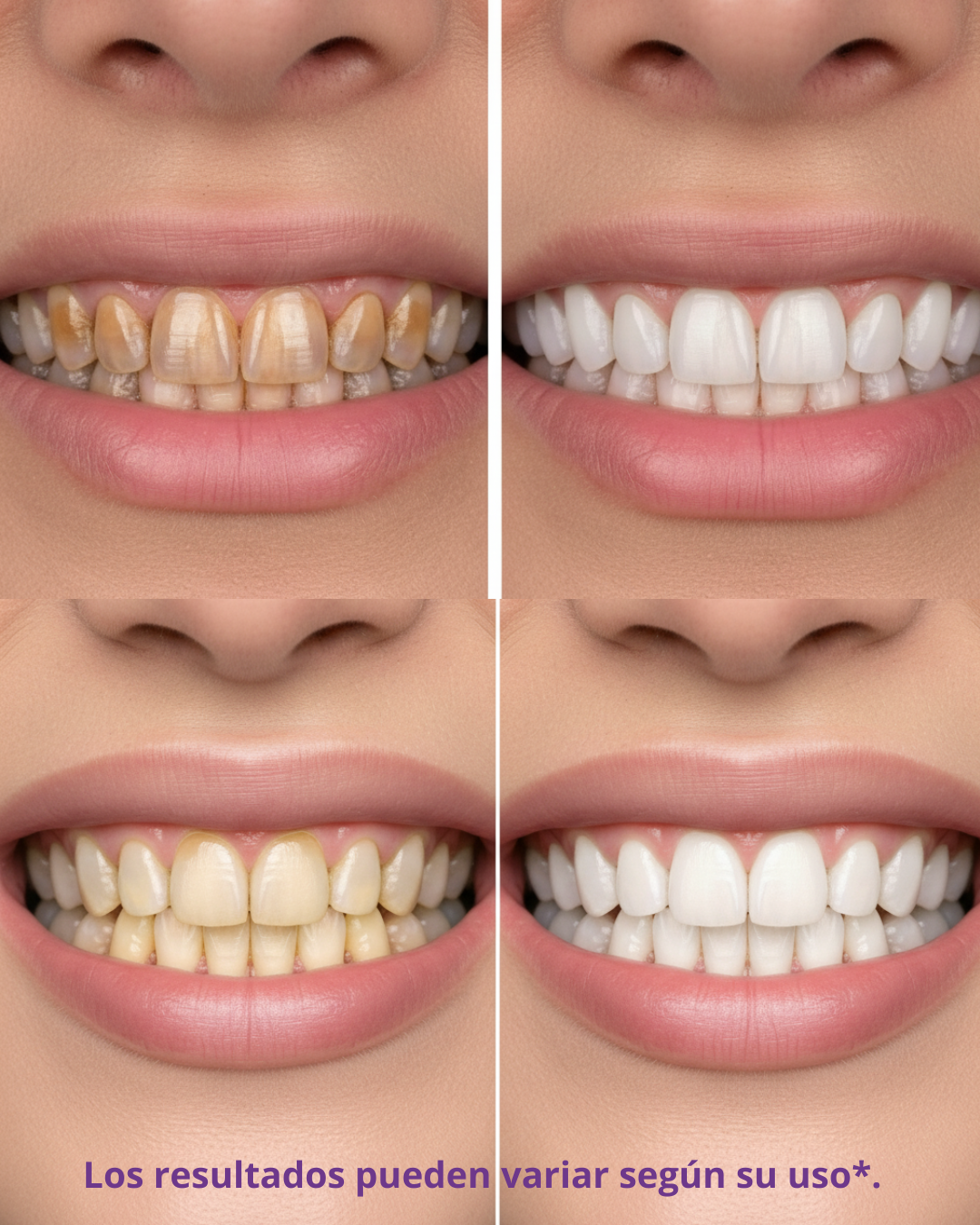 🦷 SmileUp™ PurpleFix™ – Blanqueador Dental Instantáneo en Pasta Elimina manchas y aclara tus dientes desde el primer uso